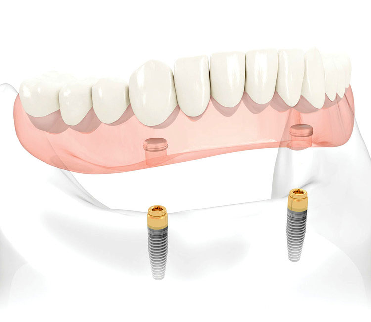 Removable Implant Supported Teeth
