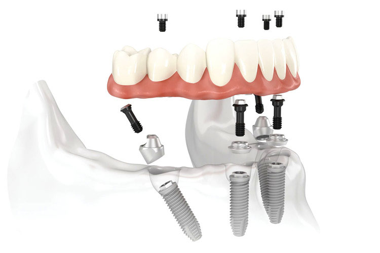 Permanent Implant Retained Teeth
